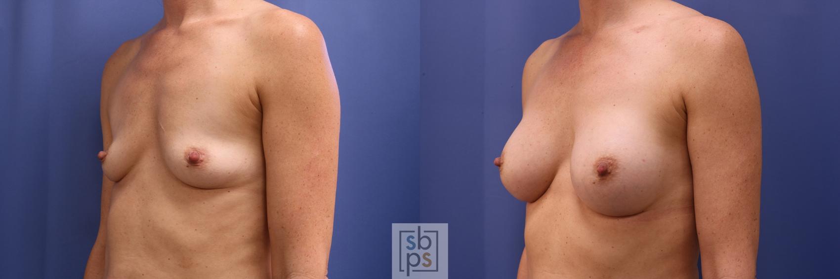 Before & After Breast Augmentation Case 449 Left Oblique View in Torrance & Los Angeles, CA, CA