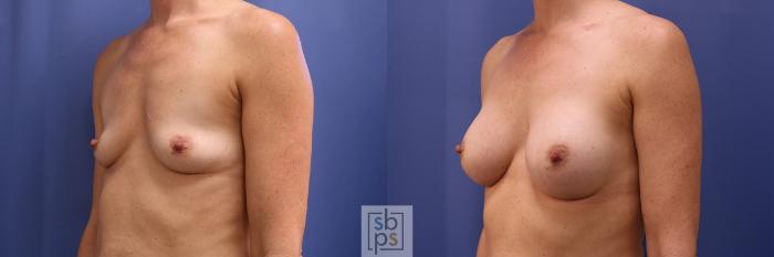 Before & After Breast Augmentation Case 449 Left Oblique View in Torrance, CA