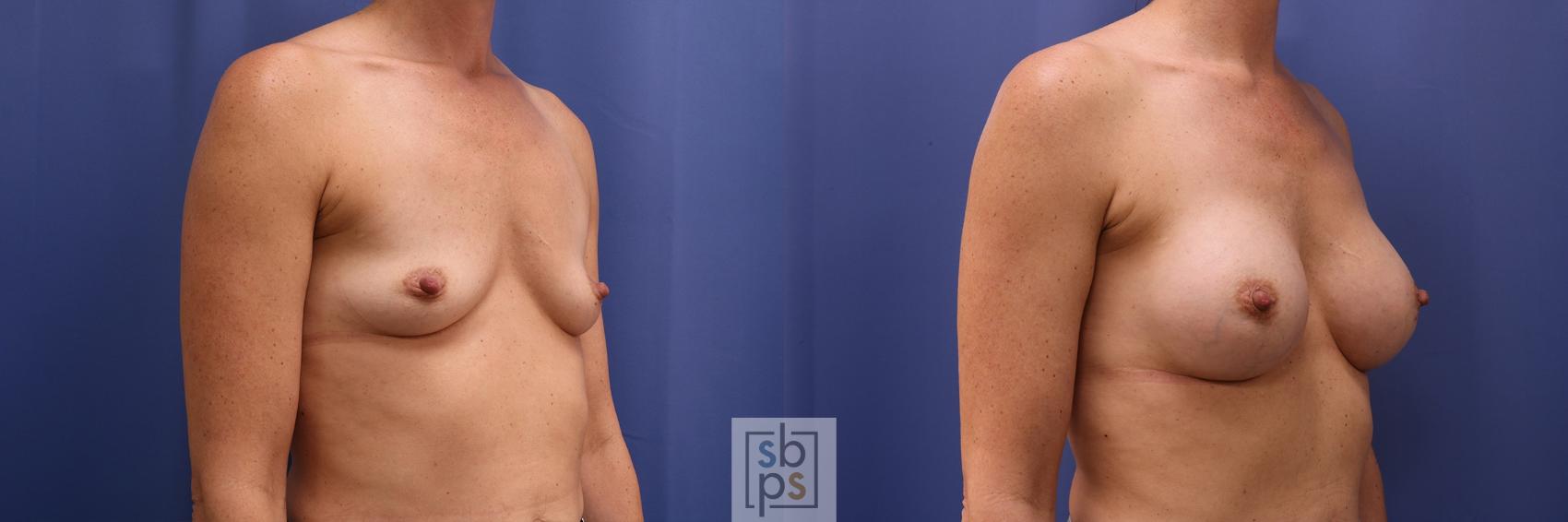 Before & After Breast Augmentation Case 449 Right Oblique View in Torrance & Los Angeles, CA, CA