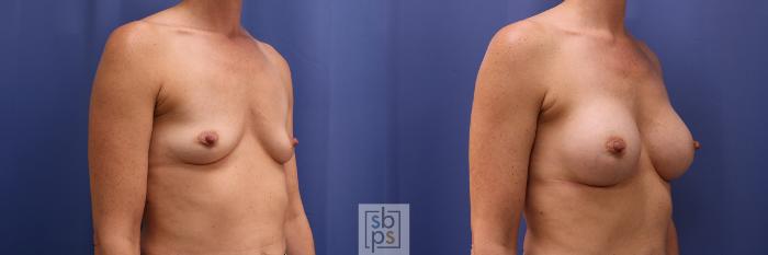 Before & After Breast Augmentation Case 449 Right Oblique View in Torrance, CA