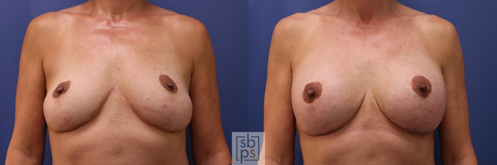 Before & After Breast Lift Case 452 Front View in Torrance, CA