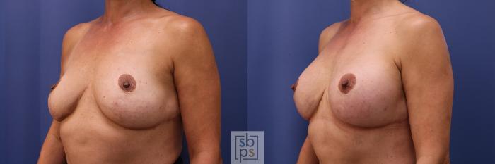 Before & After Breast Augmentation Case 452 Left Oblique View in Torrance, CA