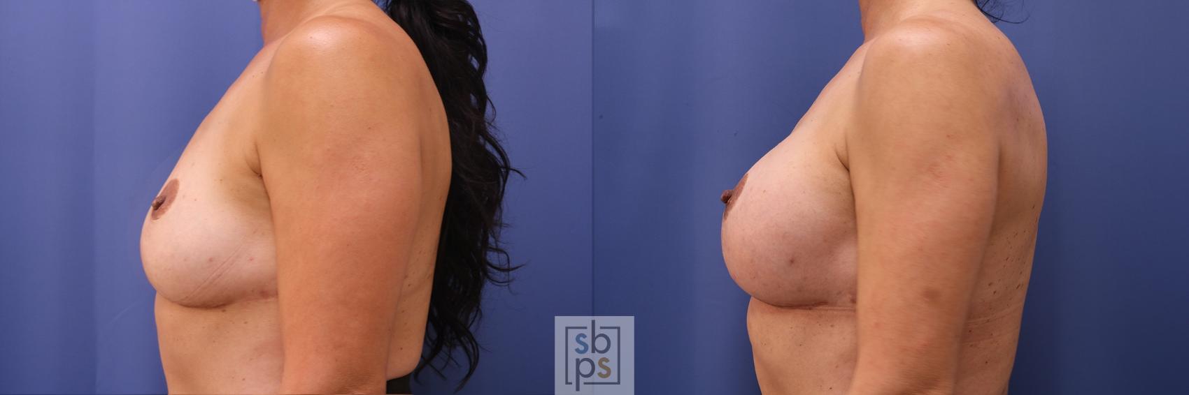 Before & After Breast Lift Case 452 Left Side View in Torrance & Los Angeles, CA, CA