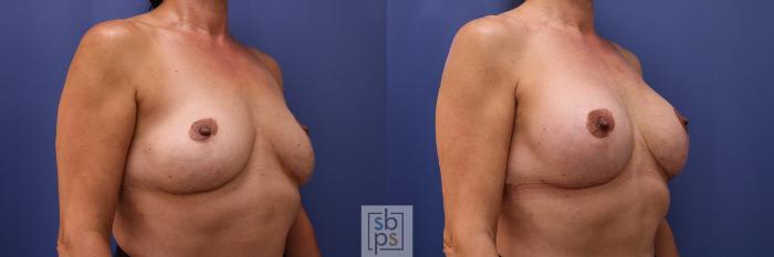 Before & After Breast Augmentation Case 452 Right Oblique View in Torrance, CA