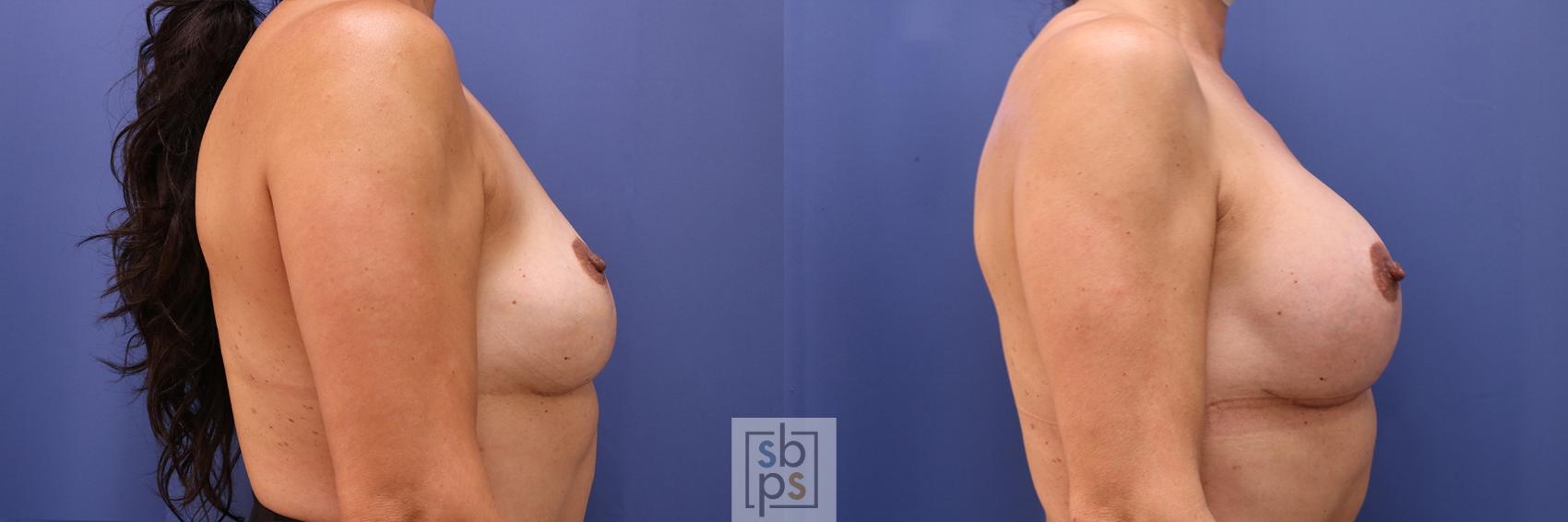 Before & After Breast Lift Case 452 Right Side View in Torrance & Los Angeles, CA, CA