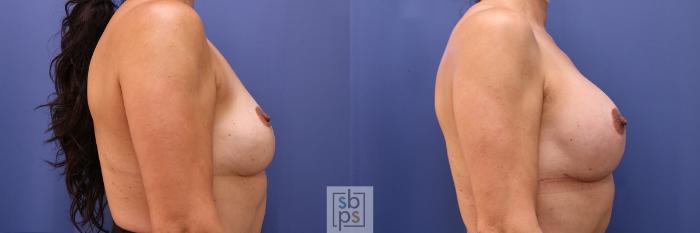 Before & After Breast Lift Case 452 Right Side View in Torrance, CA