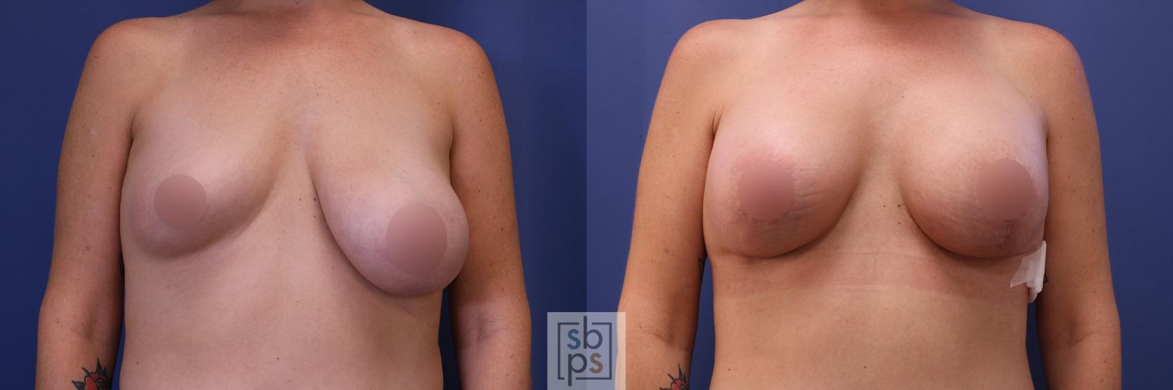 Before & After Breast Reduction Case 457 Front View View in Torrance, CA