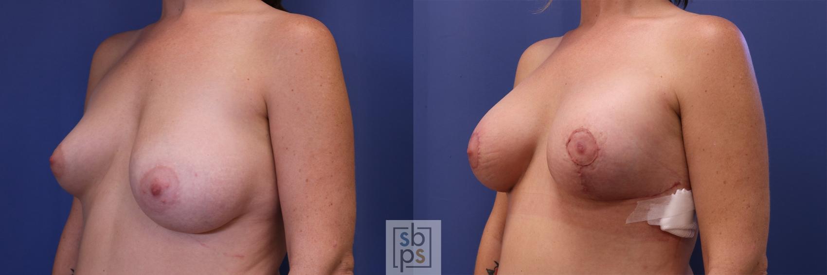 Before & After Breast Reduction Case 457 Left Oblique View in Torrance, CA