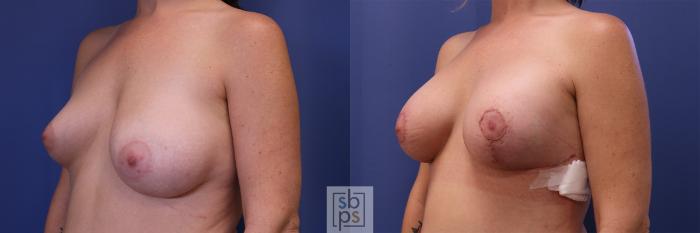 Before & After Breast Augmentation Case 457 Left Oblique View in Torrance, CA