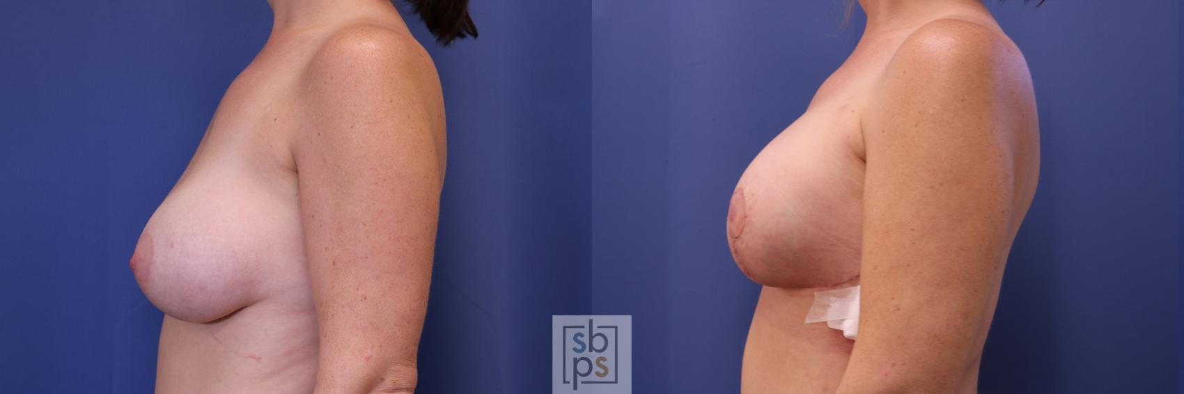 Before & After Breast Reduction Case 457 Left Side View in Torrance, CA