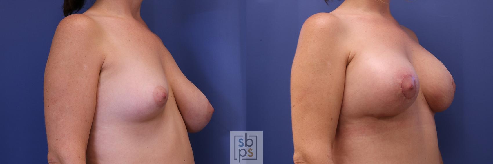 Before & After Breast Reduction Case 457 Right Oblique View in Torrance, CA