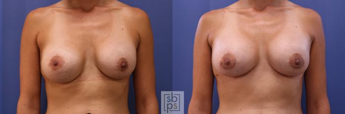 Before & After Breast Augmentation Case 466 Front View in Torrance, CA