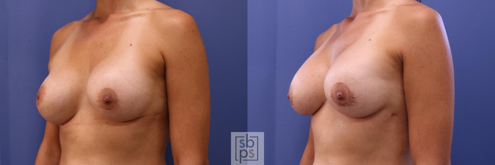 Before & After Breast Augmentation Case 466 Left Oblique View in Torrance & Los Angeles, CA, CA