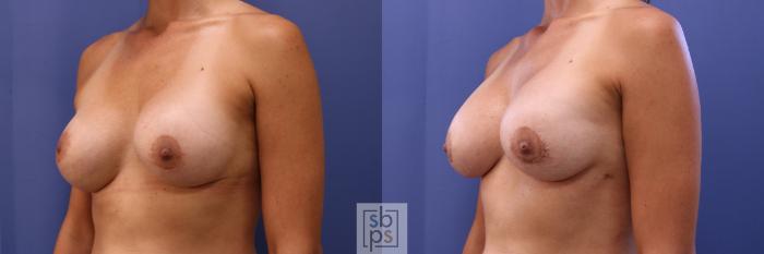 Before & After Breast Augmentation Case 466 Left Oblique View in Torrance, CA