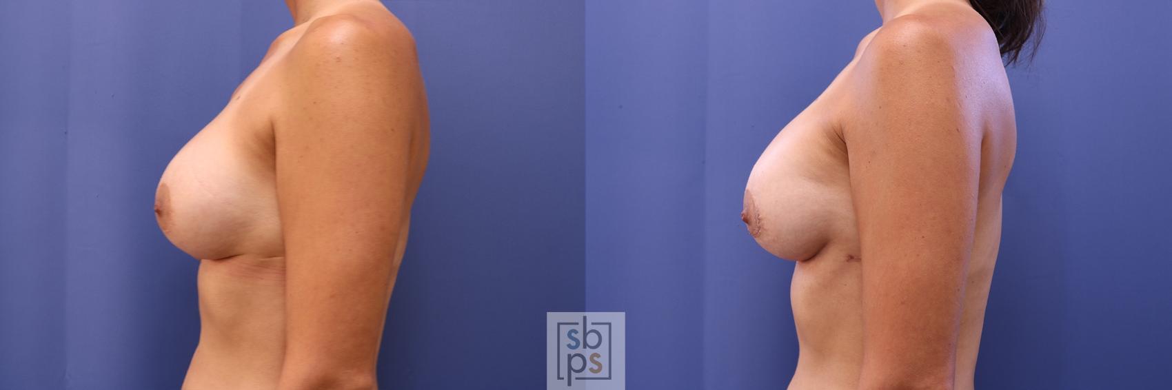 Before & After Breast Augmentation Case 466 Left Side View in Torrance & Los Angeles, CA, CA
