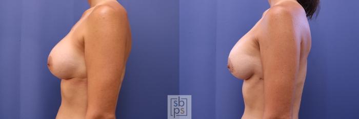 Before & After Breast Augmentation Case 466 Left Side View in Torrance, CA
