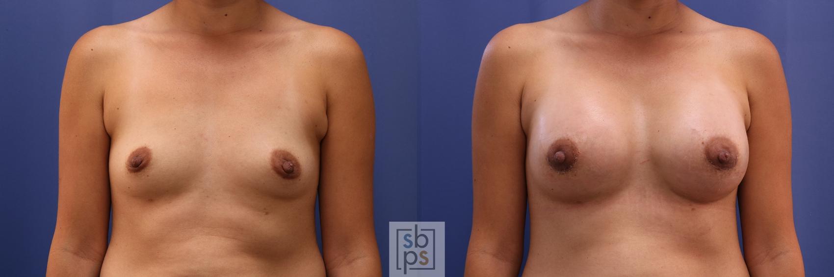 Before & After Breast Augmentation Case 468 Front View in Torrance, CA
