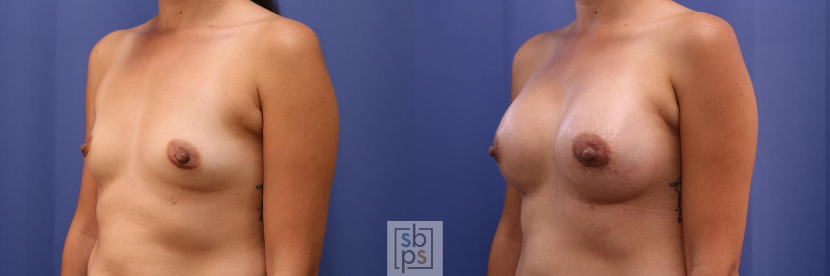 Before & After Breast Augmentation Case 468 Left Oblique View in Los Angeles, Torrance & Long Beach, CA