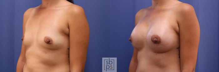 Before & After Breast Augmentation Case 468 Left Oblique View in Torrance, CA