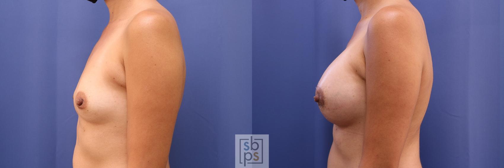 Before & After Breast Augmentation Case 468 Left Side View in Los Angeles, Torrance & Long Beach, CA