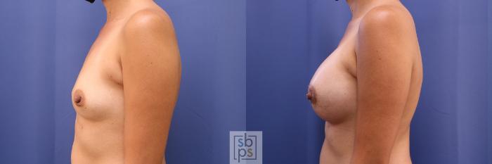 Before & After Breast Augmentation Case 468 Left Side View in Torrance, CA