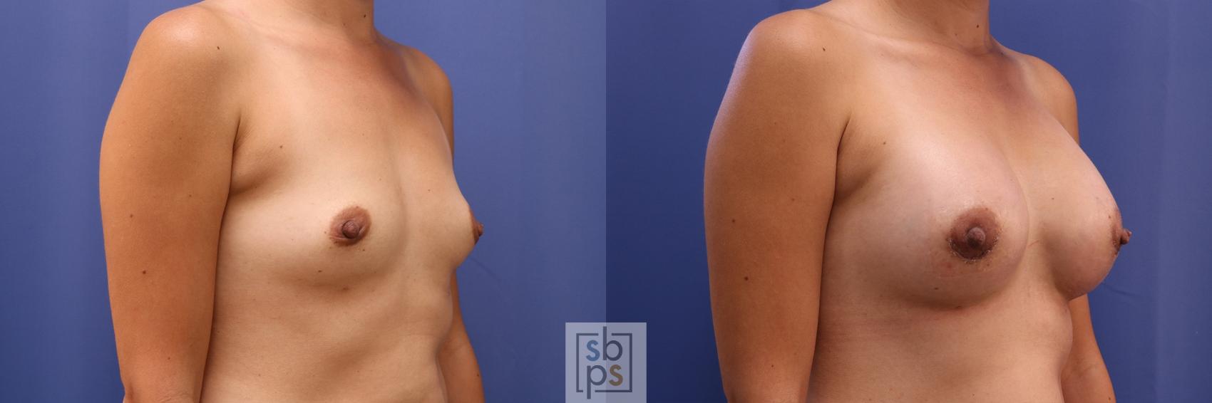 Before & After Breast Augmentation Case 468 Right Oblique View in Los Angeles, Torrance & Long Beach, CA