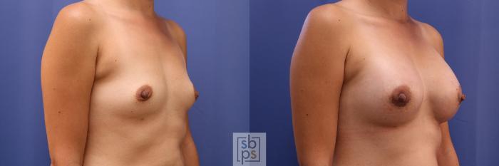 Before & After Breast Augmentation Case 468 Right Oblique View in Torrance, CA