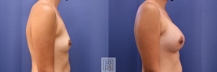 Before & After Breast Augmentation Case 468 Right Side View in Torrance, CA