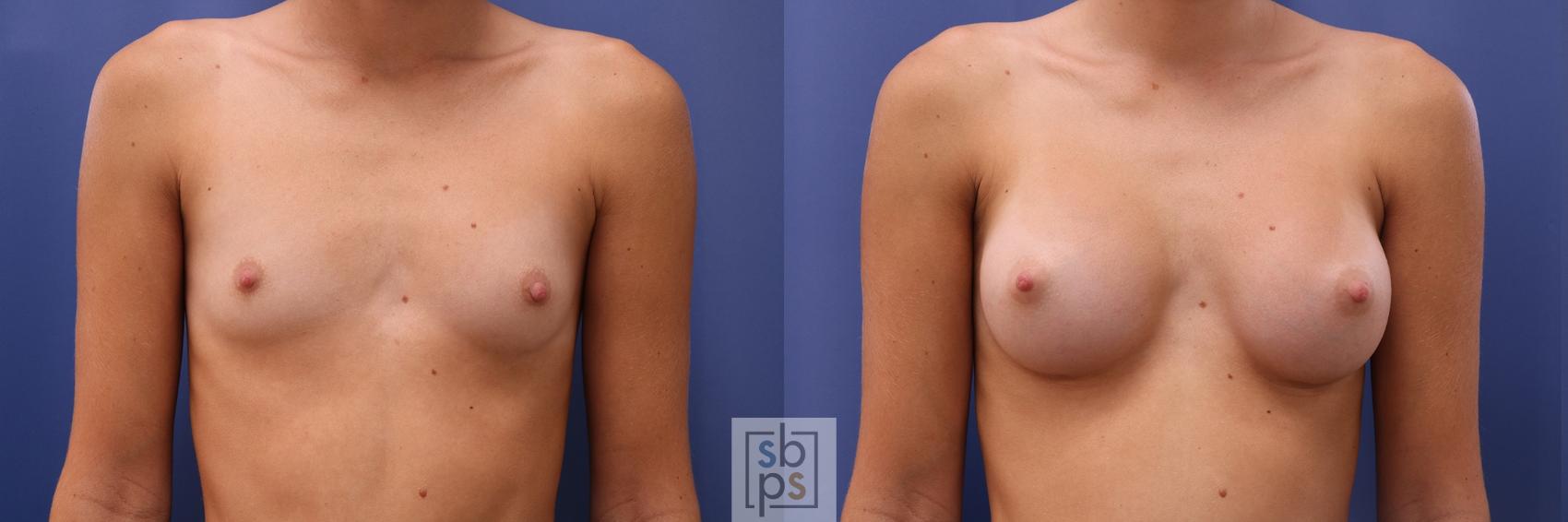 Before & After Breast Augmentation Case 469 Front View in Torrance, CA