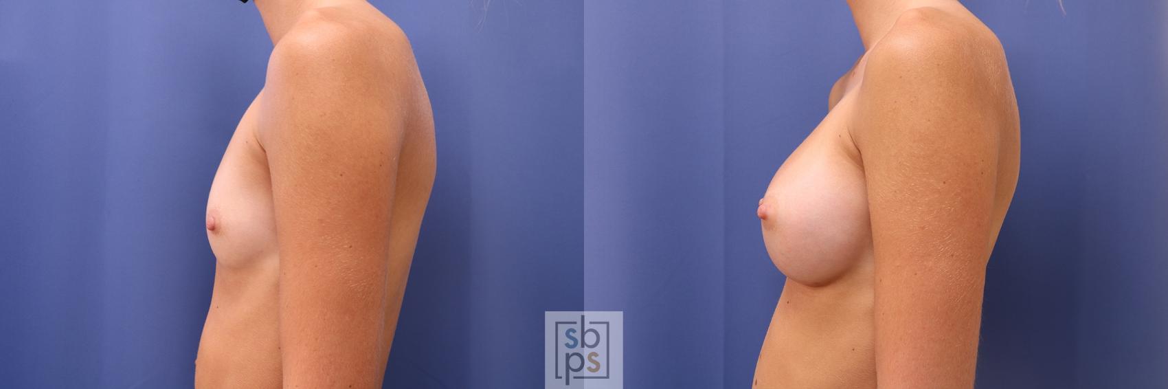 Before & After Breast Augmentation Case 469 Left Side View in Torrance & Los Angeles, CA, CA