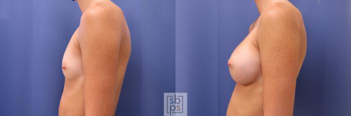 Before & After Breast Augmentation Case 469 Left Side View in Torrance, CA