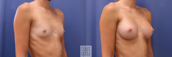 Before & After Breast Augmentation Case 469 Right Oblique View in Torrance, CA
