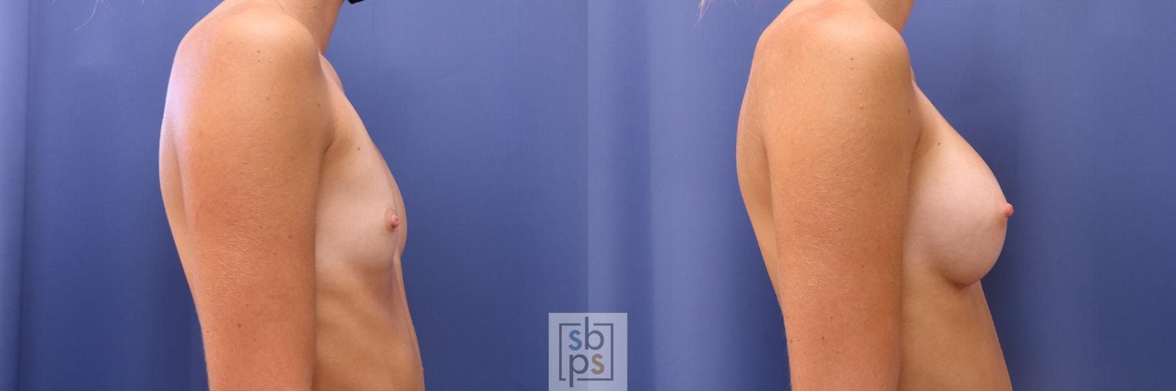 Before & After Breast Augmentation Case 469 Right Side View in Torrance & Los Angeles, CA, CA