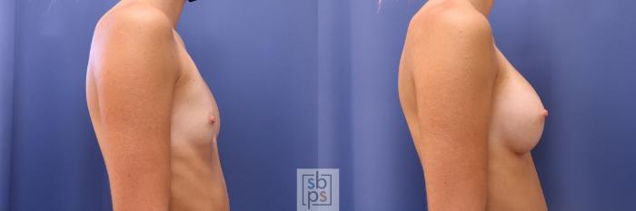 Before & After Breast Augmentation Case 469 Right Side View in Torrance, CA
