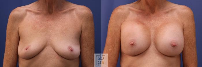 Before & After Breast Augmentation Case 474 Front View in Torrance, CA