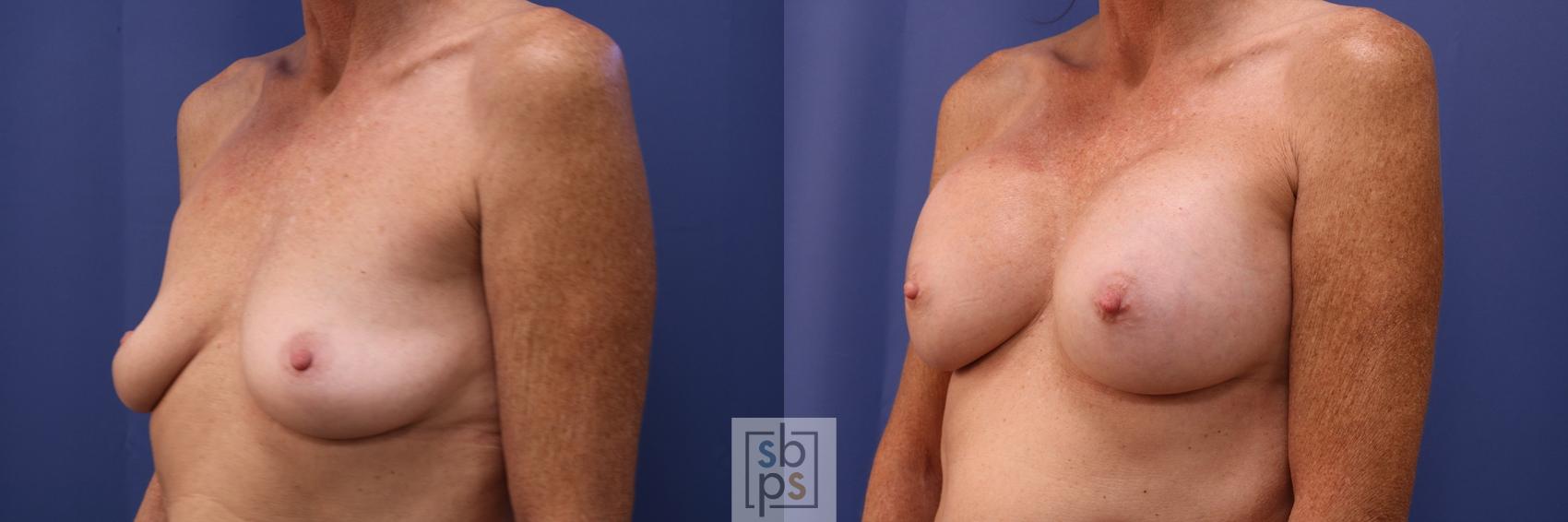Before & After Breast Augmentation Case 474 Left Oblique View in Los Angeles, Torrance & Long Beach, CA