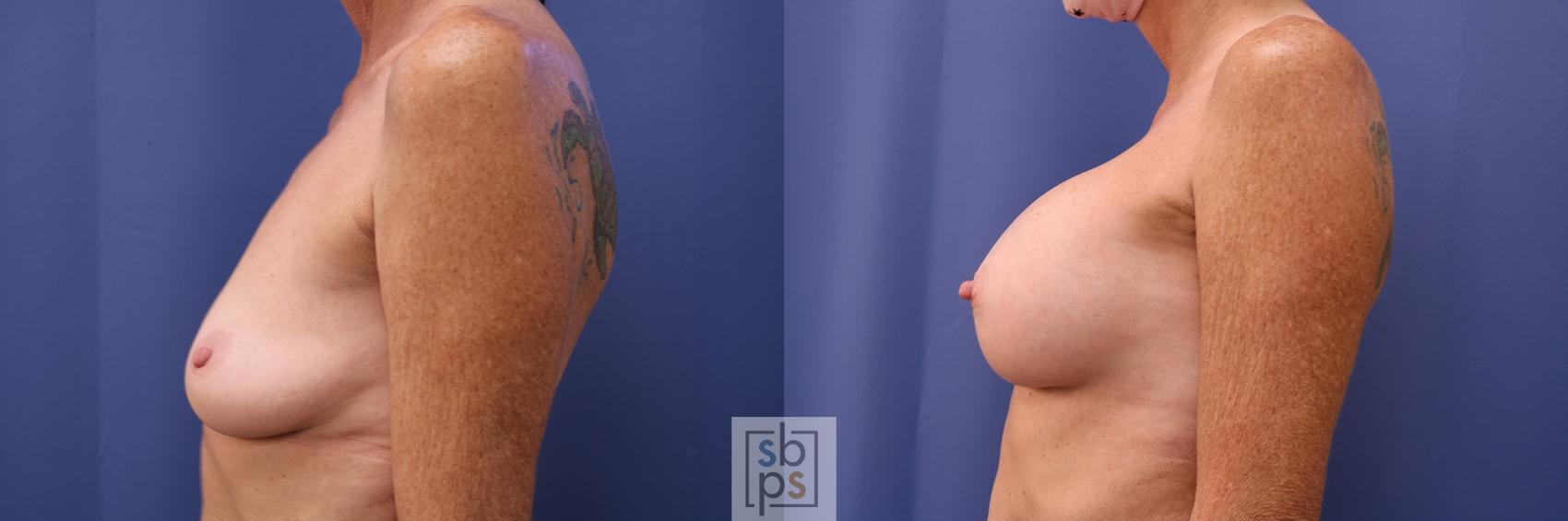 Before & After Breast Augmentation Case 474 Left Side View in Los Angeles, Torrance & Long Beach, CA