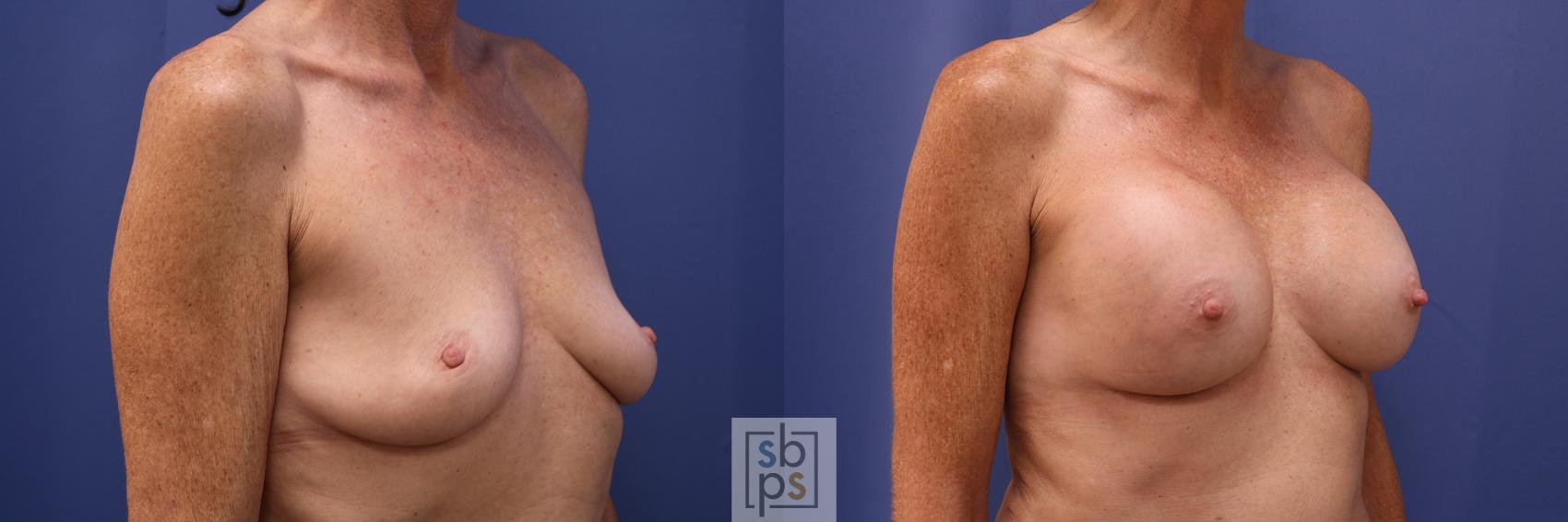 Before & After Breast Augmentation Case 474 Right Oblique View in Los Angeles, Torrance & Long Beach, CA