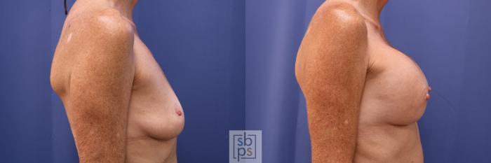 Before & After Breast Augmentation Case 474 Right Side View in Torrance, CA