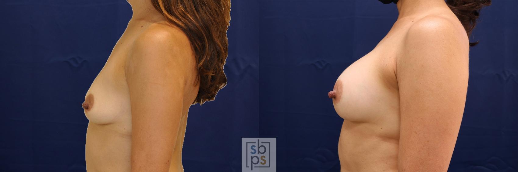 Before & After Breast Augmentation Case 478 Left Side View in Torrance & Los Angeles, CA, CA
