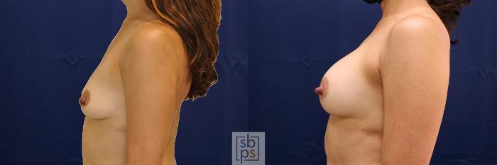 Before & After Breast Augmentation Case 478 Left Side View in Torrance, CA