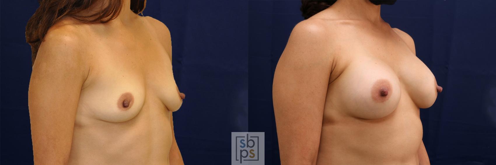 Before & After Breast Augmentation Case 478 Right Oblique View in Torrance & Los Angeles, CA, CA