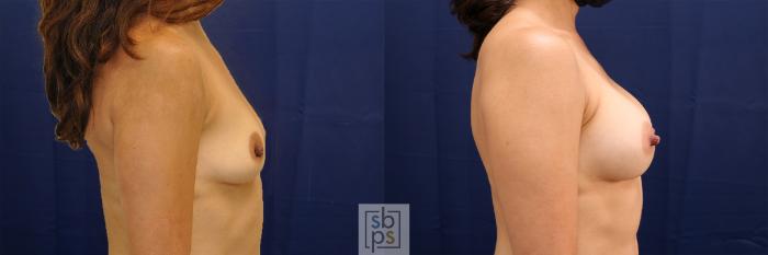 Before & After Breast Augmentation Case 478 Right Side View in Torrance, CA