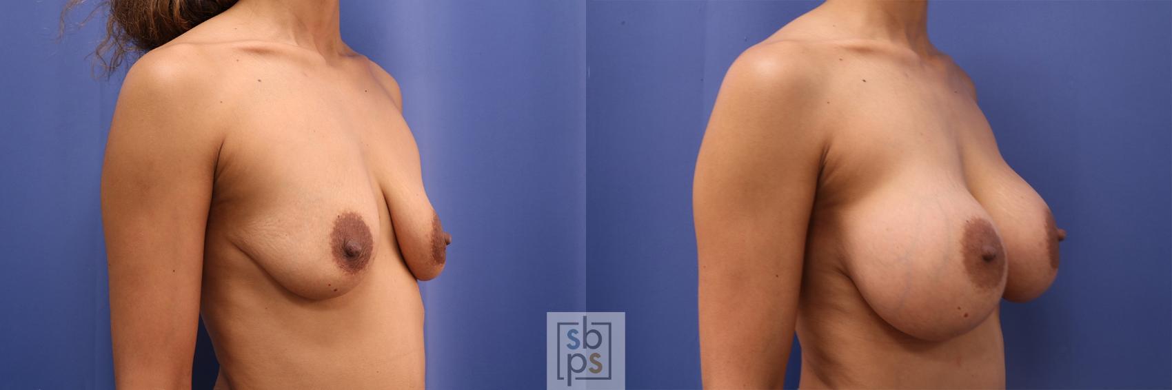 Before & After Breast Augmentation Case 482 Right Oblique View in Torrance & Los Angeles, CA, CA