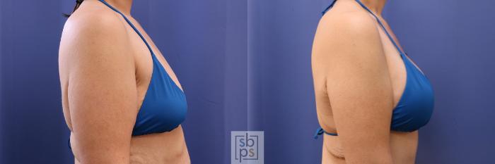 Before & After Breast Augmentation Case 484 Bikini Right View in Torrance, CA