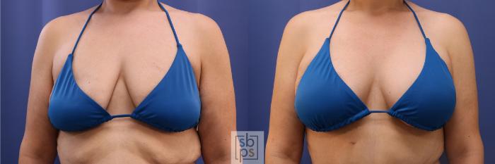 Before & After Breast Augmentation Case 484 Bikini View in Torrance, CA
