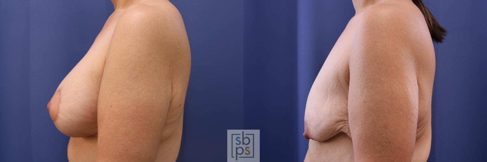 Before & After Breast Augmentation Case 484 Left Side View in Los Angeles, Torrance & Long Beach, CA