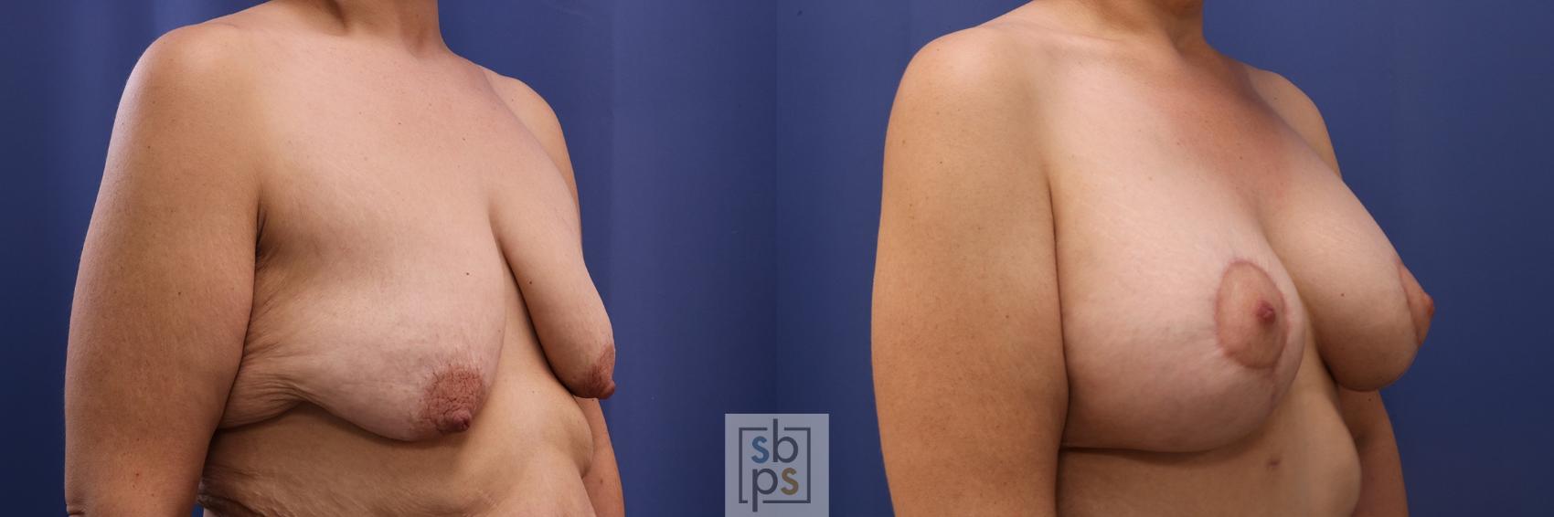 Before & After Breast Augmentation Case 484 Right Oblique View in Los Angeles, Torrance & Long Beach, CA