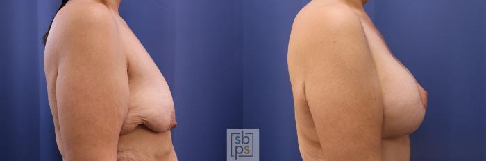 Before & After Breast Augmentation Case 484 Right Side View in Torrance, CA
