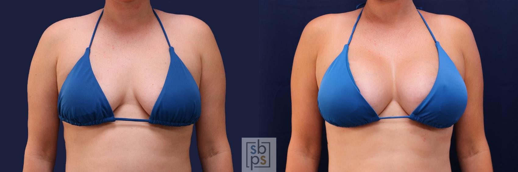 Before & After Breast Augmentation Case 488 Bikini - Front View in Torrance & Los Angeles, CA, CA